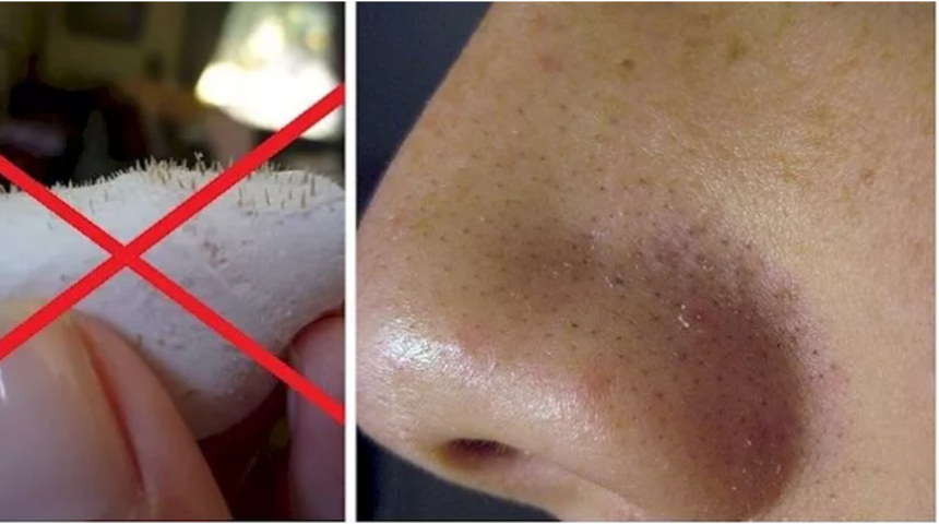 Siyah nokta temizleme için bitkisel çözümler! Kökünden çözeceksiniz