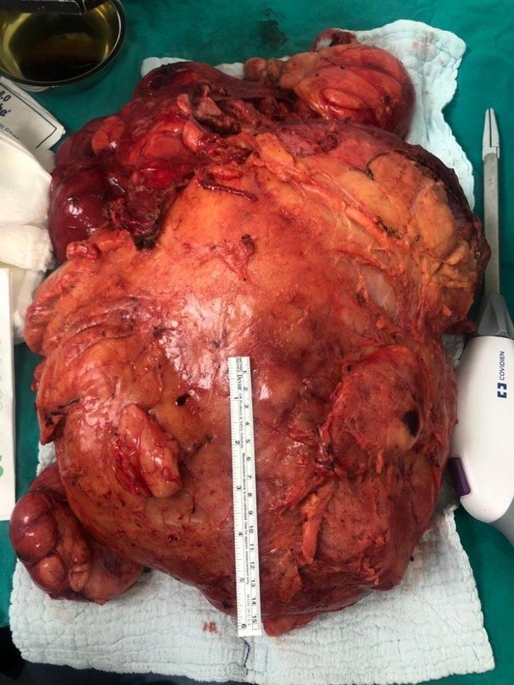 Şişlik nedeniyle gittiği hastanede karnında 11 kiloluk kitle olduğunu öğrendi G2