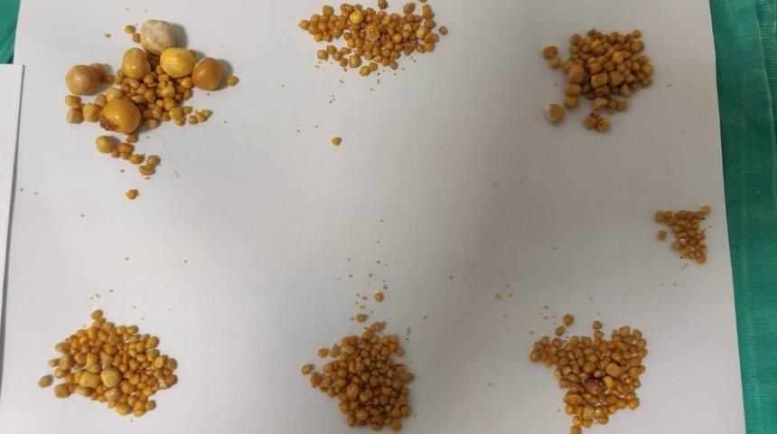 Manisa'da inanılmaz olay! Safra kesesinden bin 122 taş çıkarıldı