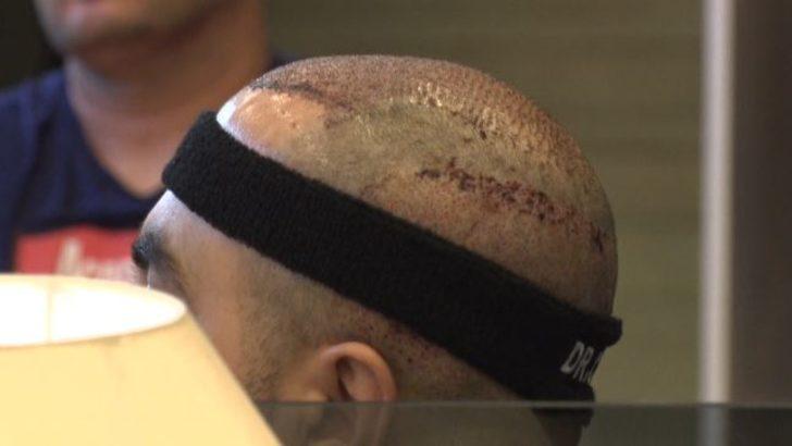 Türkiye saç ekiminde birinci sırada; En çok İtalyanlar geliyor G4