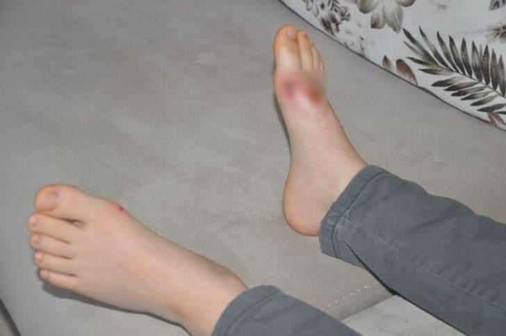 Kartopu oynarken vücudunda yaralar oluşmuştu! Akılalmaz iddia... G1