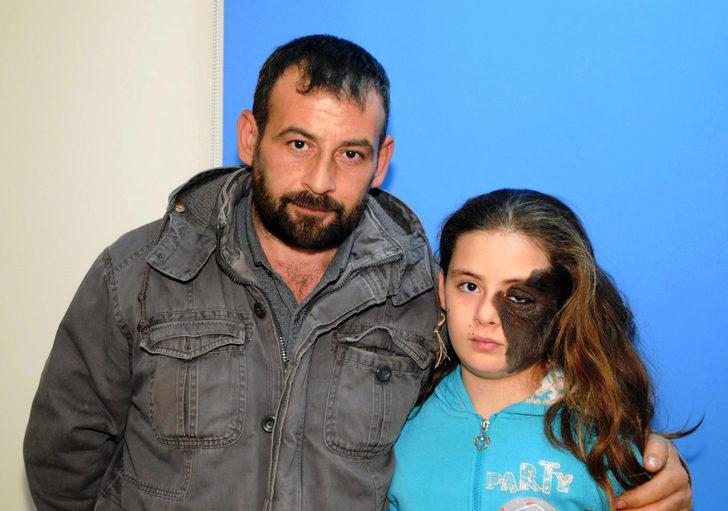 Hatay'da yüzünde dev ben olan Nazlı 11 yıl sonra tedavi olacak G1
