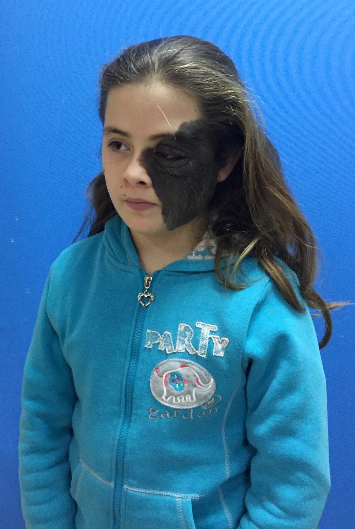 Hatay'da yüzünde dev ben olan Nazlı 11 yıl sonra tedavi olacak G2