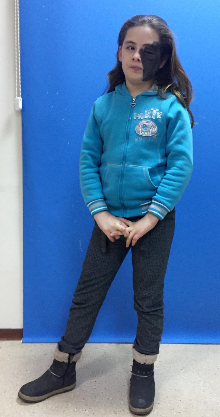 Hatay'da yüzünde dev ben olan Nazlı 11 yıl sonra tedavi olacak G3