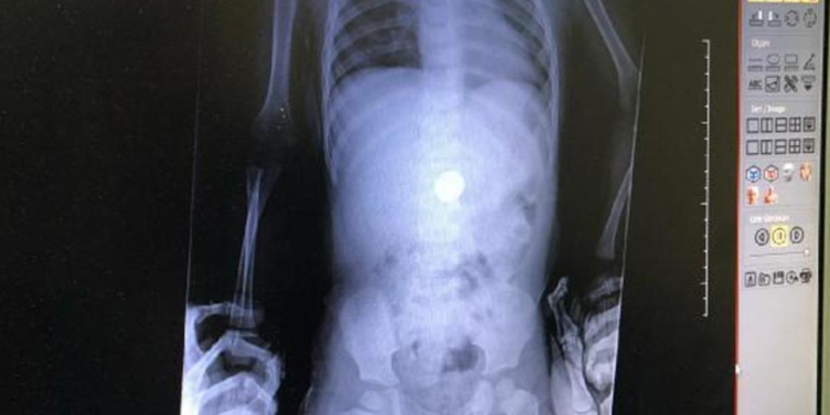 Aileler dikkat! R&ouml;ntgende belli oldu