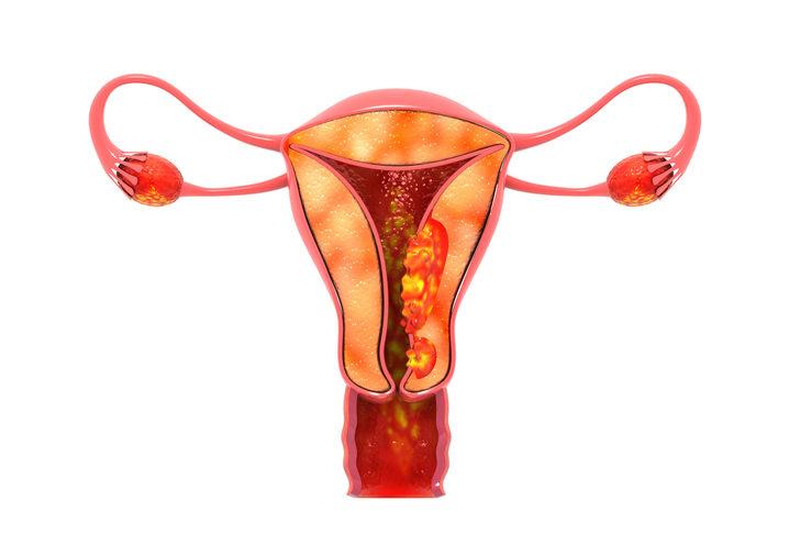 Rahim ağzı kanseri belirtileri neler? Rahim ağzı kanseri taraması hayat kurtarıyor G2