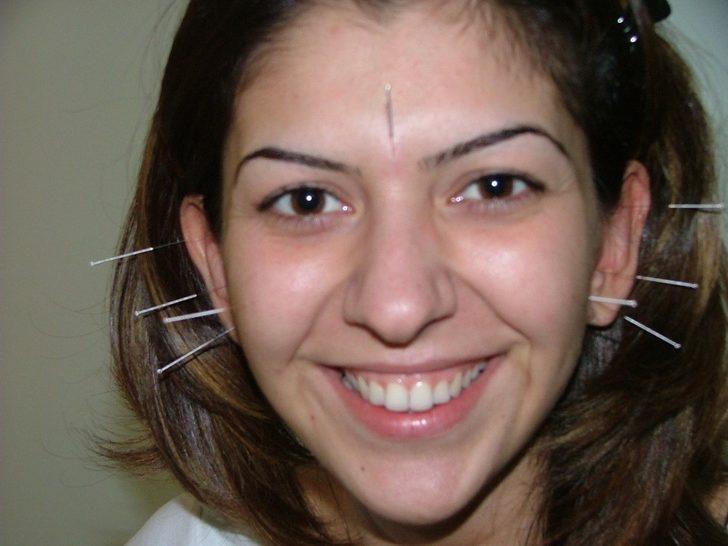 Akupunkturla şeker tedavisi mümkün mü? G1