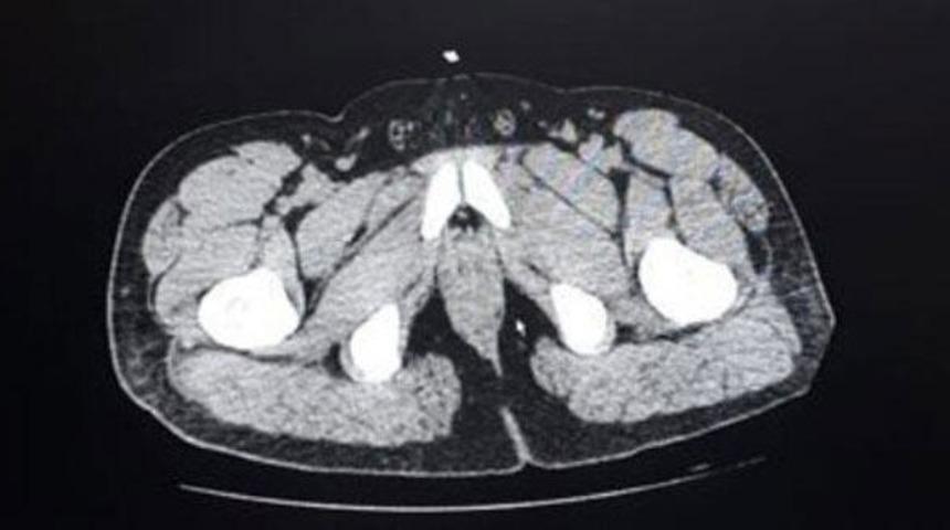 Mide ve bağırsaklarında 100 paket metamfetamin tespit edilen 2 kişi tutuklandı