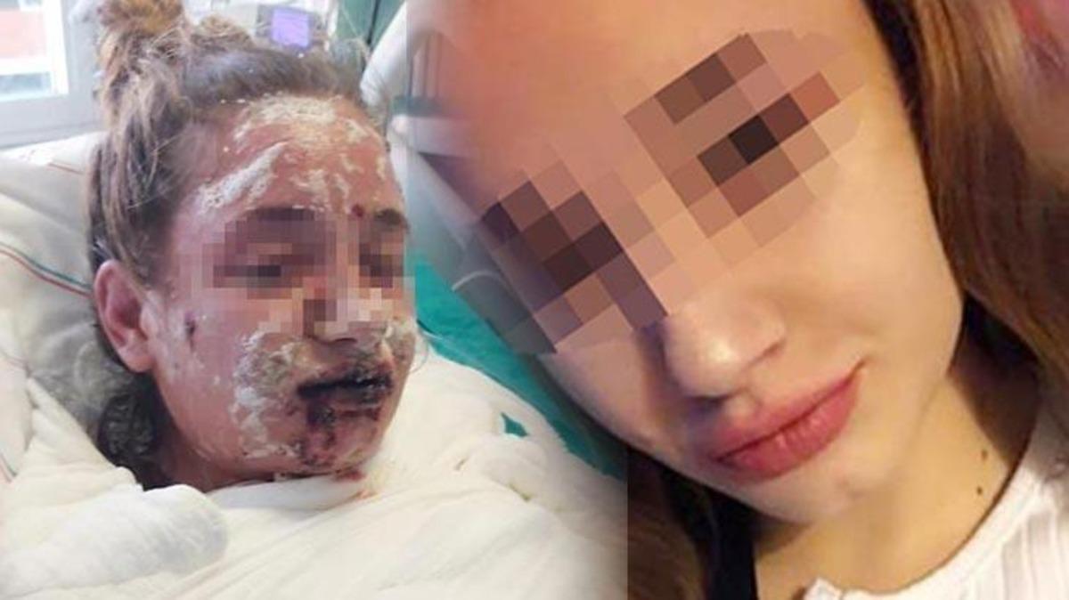 Aldığı ila&ccedil; liseli Mina'nın hayatını kabusa &ccedil;evirdi! V&uuml;cudu yandı, g&ouml;rme yetisini kaybetti