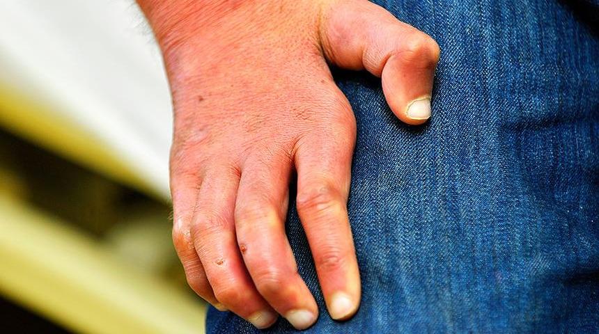 Sağlık Bakanlığı açıkladı! Türkiye'de 2019'da 2 yeni cüzzam vakası görüldü