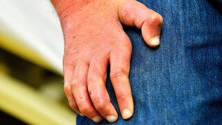 Sağlık Bakanlığı açıkladı! Türkiye'de 2019'da 2 yeni cüzzam vakası görüldü