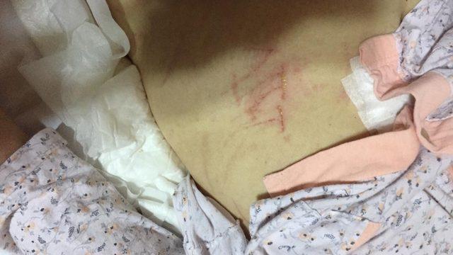 Denizli’de yatalak ALS hastasının karnına tırnakla ‘ATT’ yazıldı iddiası