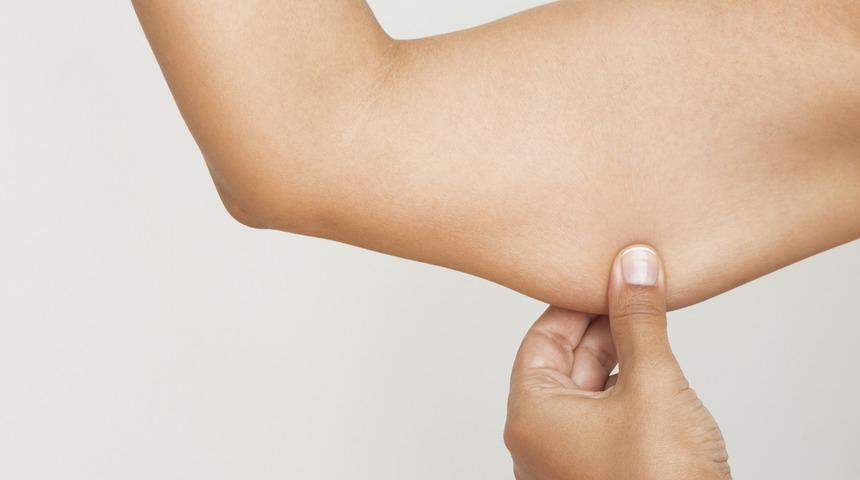 Post bariatri ile obezitenin izlerinden kurtulun