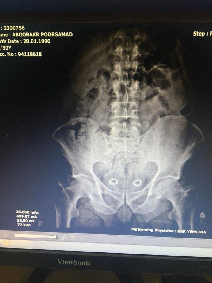 Bağırsağındaki uyuşturucu röntgende ortaya çıktı G2