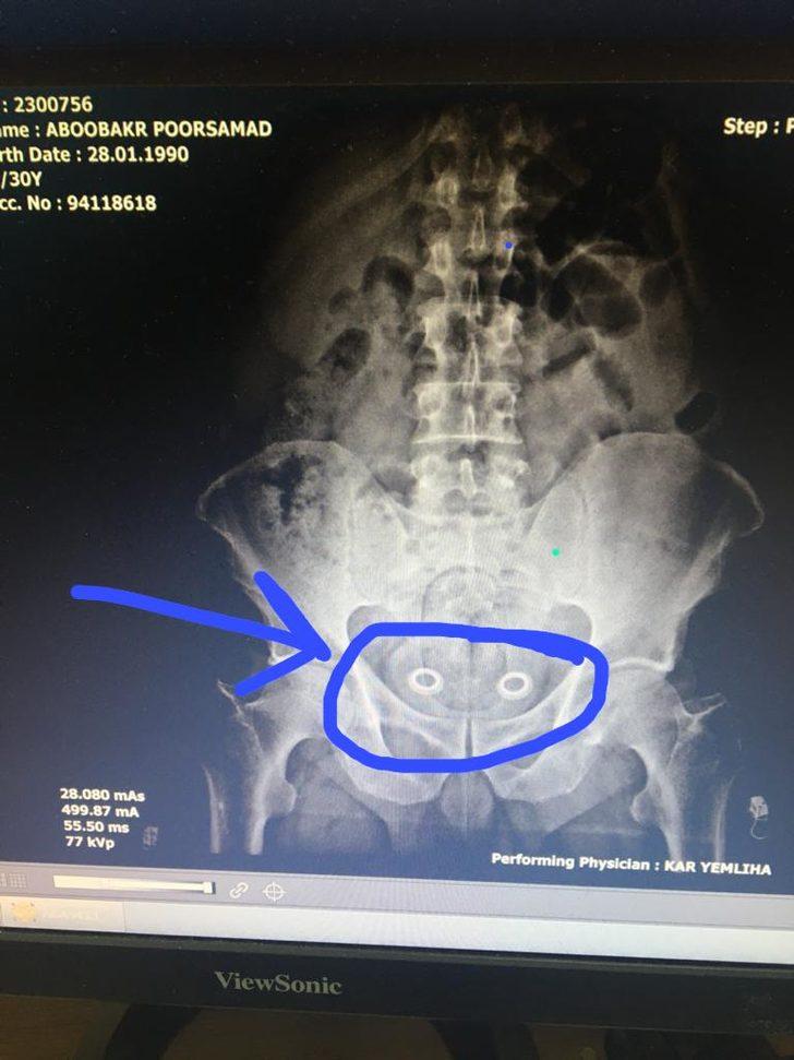 Bağırsağındaki uyuşturucu röntgende ortaya çıktı G1