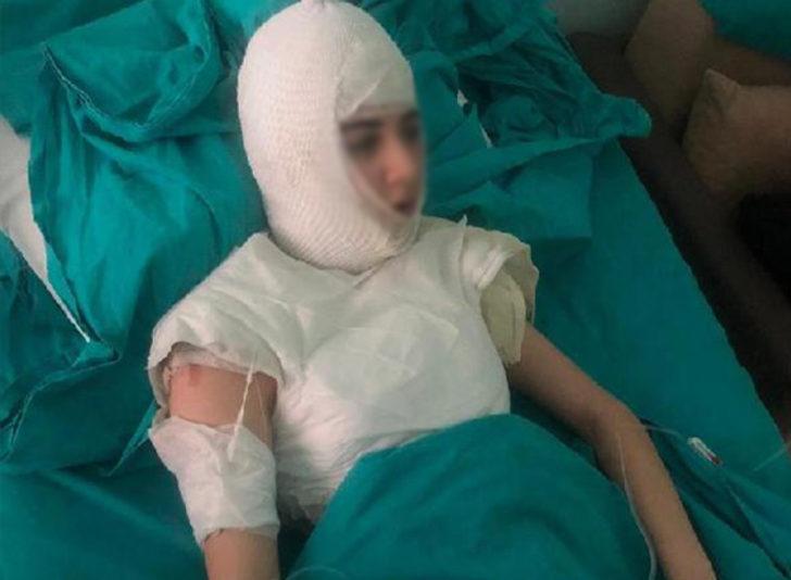 14 yaşındaki kızın başından aşağı kaynar su dökülmüştü! Mahkemeden flaş karar G2