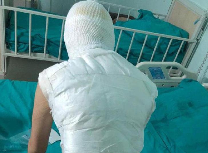 14 yaşındaki kızın başından aşağı kaynar su dökülmüştü! Mahkemeden flaş karar G5