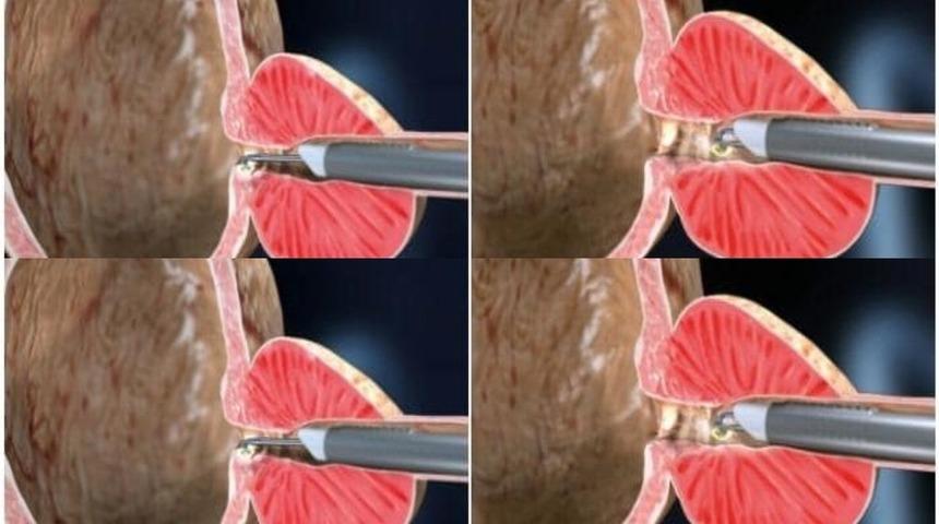 Prostat tedavisinde &ldquo;plazma kinetik TUR y&ouml;ntemi&rdquo; ile başarılı sonu&ccedil;lar alınıyor