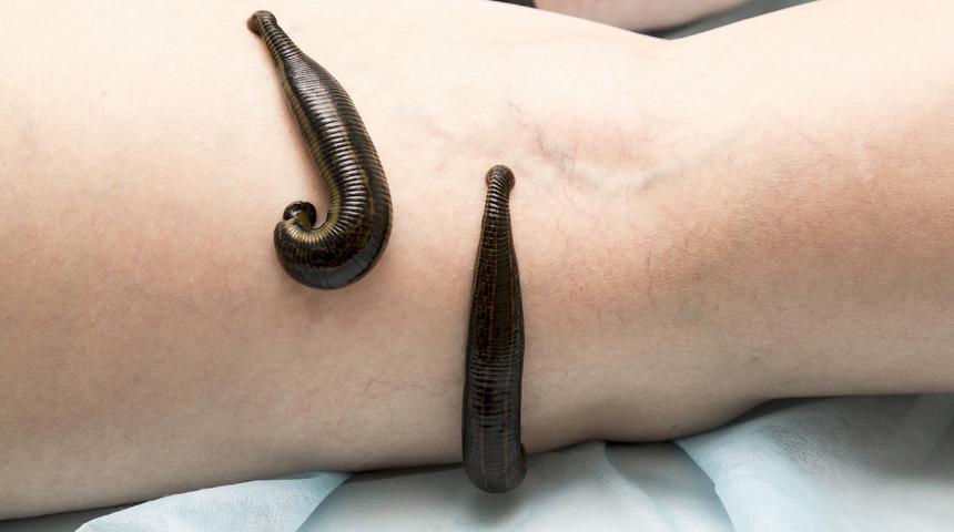 Sülük tedavisinde korona virüsü riski!