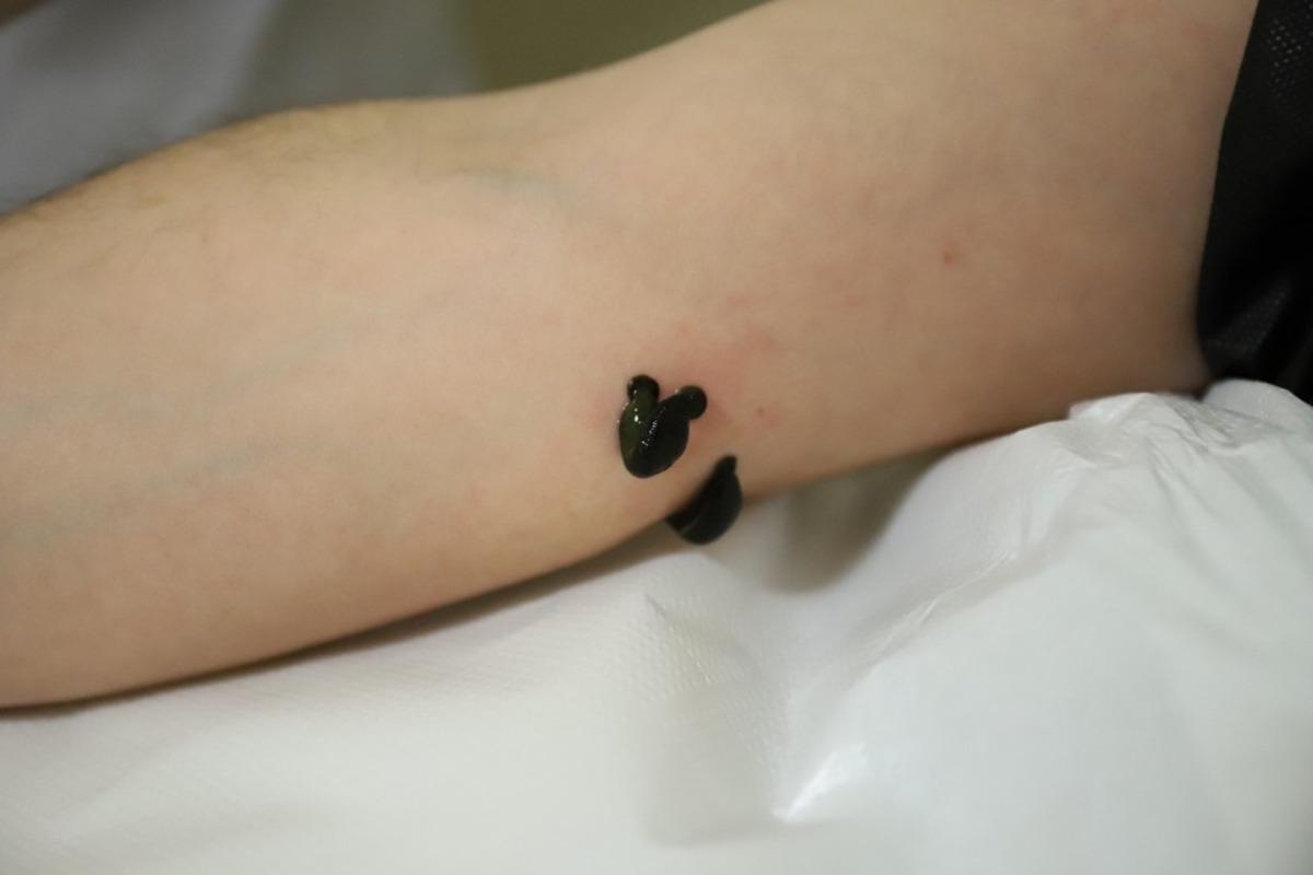 Varis ve eklem ağrılarına s&uuml;l&uuml;k tedavisi