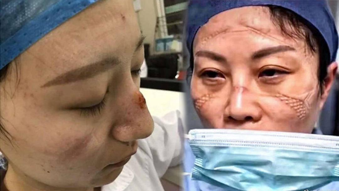 Coronavir&uuml;s&uuml;yle savaşan doktorların y&uuml;z&uuml;ndeki fedakarlık izleri