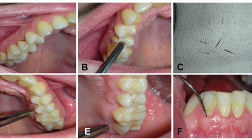 Doktorlar inanamadı! Genç kadının 'dişi kıllanıyor'