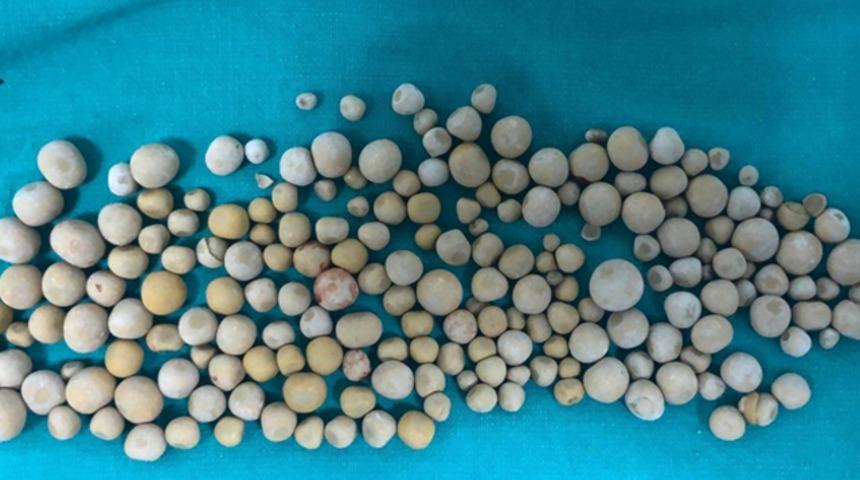 Kocaeli'de bir hastadan 199 tane taş çıkartıldı