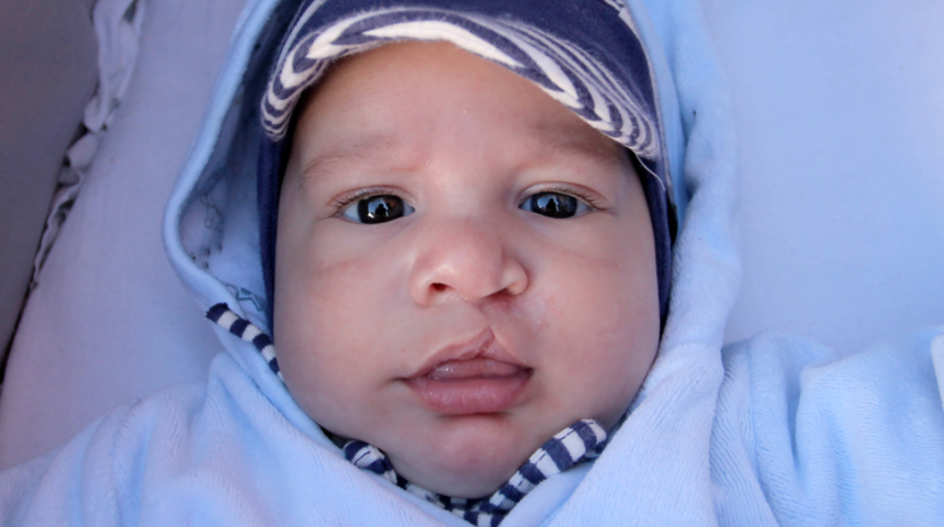 Dudak damak yarıkları her bebekte aynı mı gelişir?