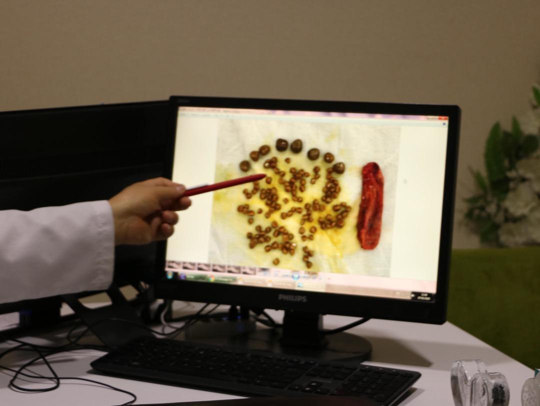 Karın ağrısıyla geldi, v&uuml;cudundan &ccedil;ıkarılanlar şoke etti!