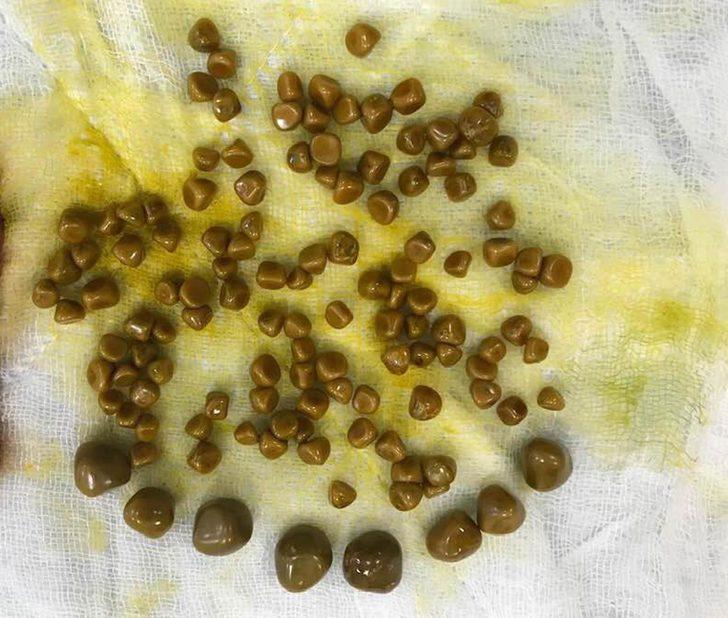 Karın ağrısıyla geldi, vücudundan çıkarılanlar şoke etti! G4