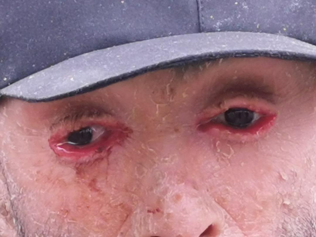 Acı i&ccedil;inde yaşıyor! Balık pulu hastası Refik'in tek hayali var 