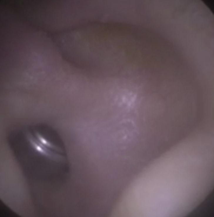 Hastanın kulağından pil çıktı G1