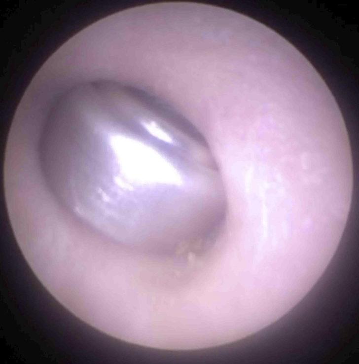 Hastanın kulağından pil çıktı G2