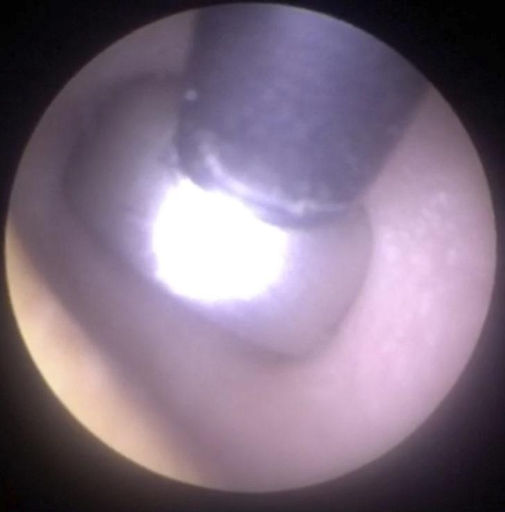 Hastanın kulağından pil çıktı G3