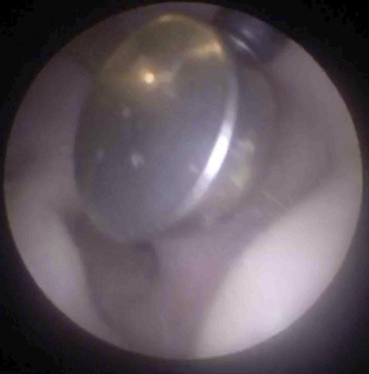 Hastanın kulağından pil çıktı G4