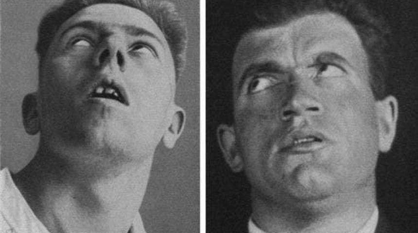 Bu hastalık milyonlarca insanı heykele dönüştürdü!