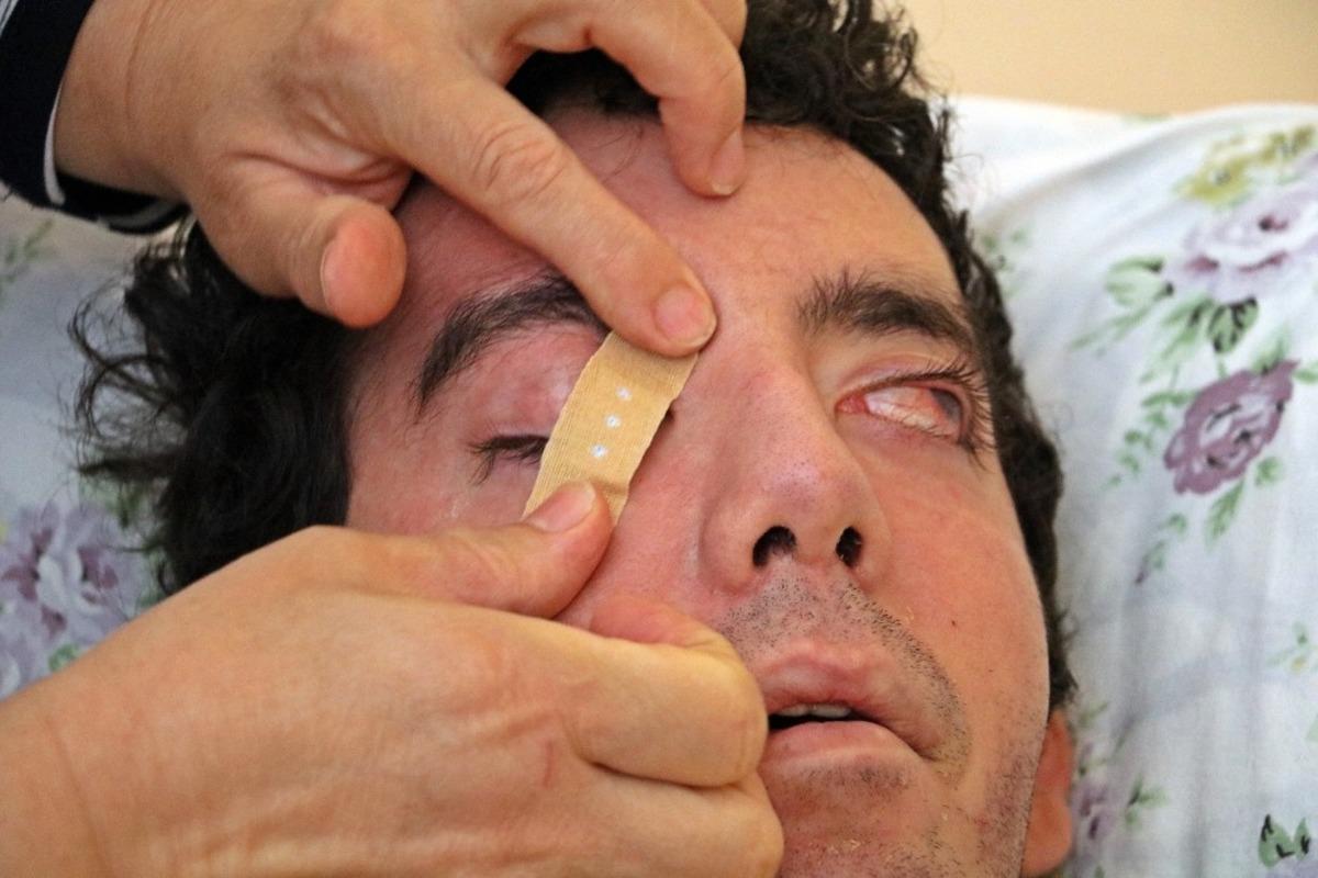 Bu acının tarifi yok... 6 yıldır g&ouml;zlerini kırpamıyor, kan &ccedil;anağına d&ouml;nen g&ouml;zleri bantla kapatılıyor