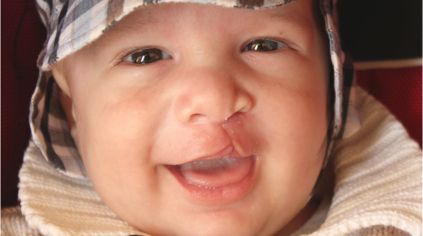 Dudak damak yarığı ameliyatı sonrası lazer uygulaması nedir?