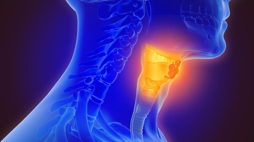 Yemek borusu kanseri belirtilerinde yutma güçlüğü ön plana çıkıyor