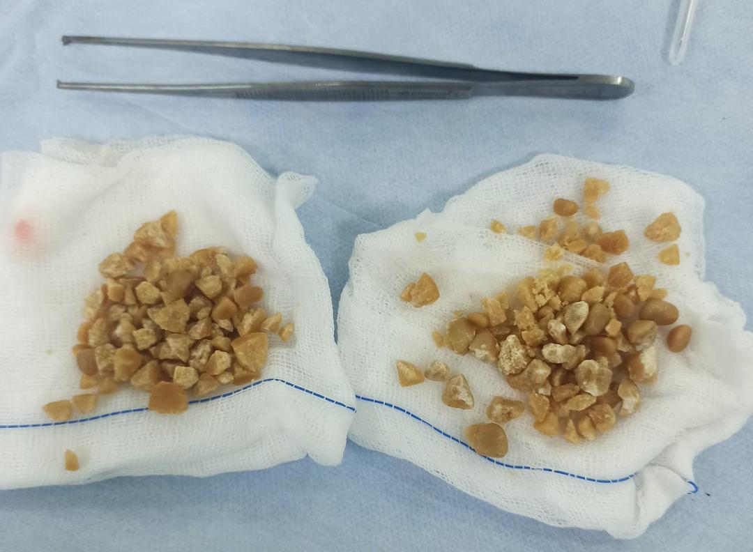 Tek b&ouml;brekli hastadan 100'e yakın taş &ccedil;ıkarıldı