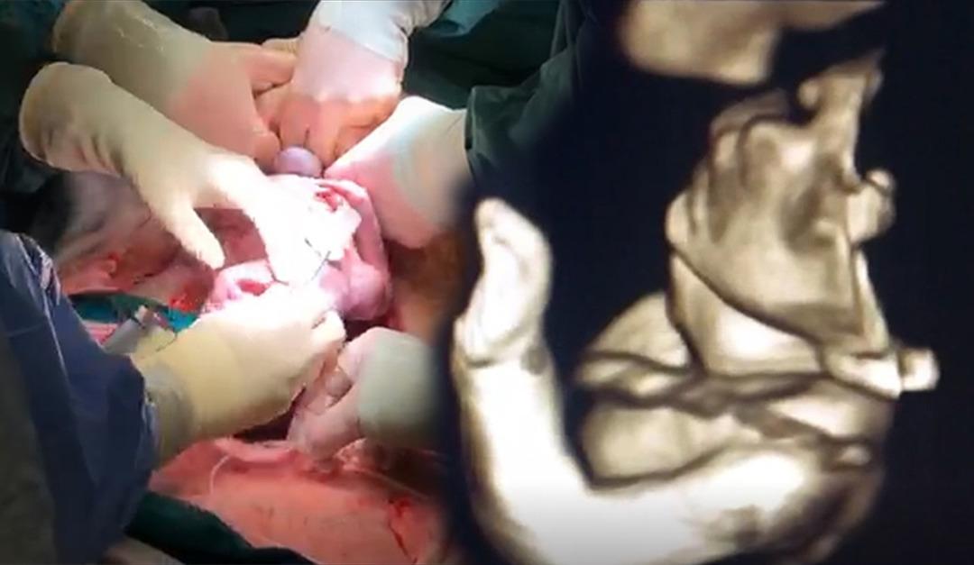 32 haftalık bebeği sezaryen doğum sırasında ameliyat ettiler!