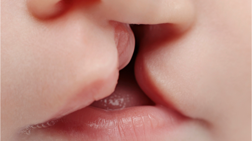 Dudak damak yarıklarında başka sorunlar da görülebilir mi?