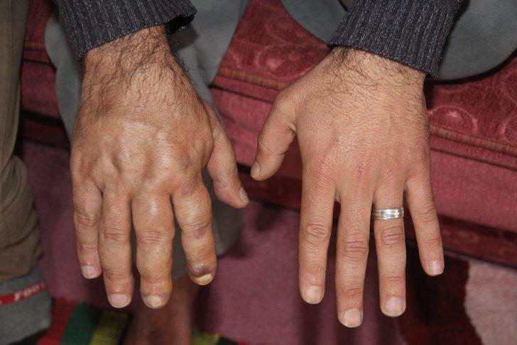 Damar genişlemesi hayatını kararttı! İki elinin farkını gören hayrete düşüyor G1