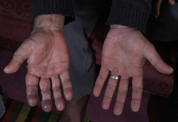 Damar genişlemesi hayatını kararttı! İki elinin farkını gören hayrete düşüyor G2