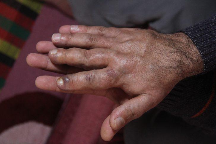 Damar genişlemesi hayatını kararttı! İki elinin farkını gören hayrete düşüyor G3