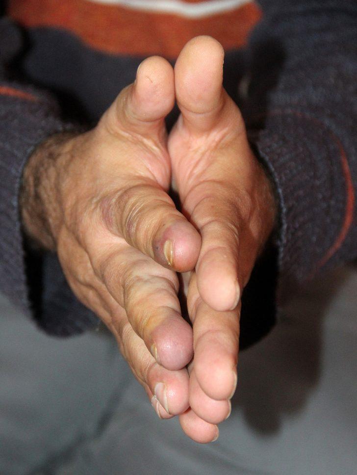 Damar genişlemesi hayatını kararttı! İki elinin farkını gören hayrete düşüyor G4