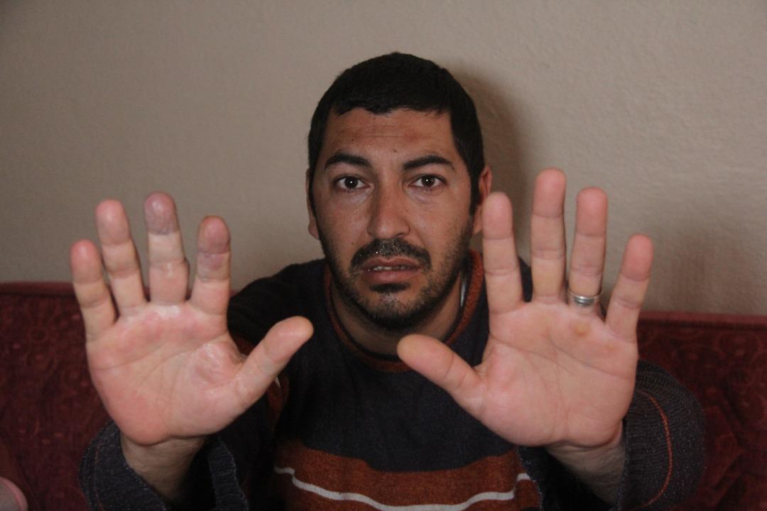 Damar genişlemesi hayatını kararttı! İki elinin farkını g&ouml;ren hayrete d&uuml;ş&uuml;yor