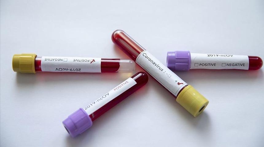 Son dakika: Azerbaycan'da koronavir&uuml;s alarmı! İlk &ouml;l&uuml;m ger&ccedil;ekleşti