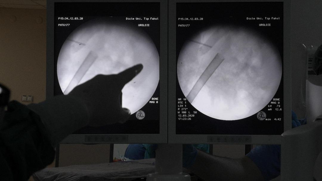 B&ouml;breğinden &ccedil;ıkan taşlar doktorları bile şaşırttı!