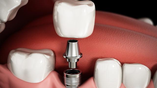 All on four tekniği ile implant tedavisi